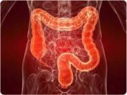 Colon Cancer